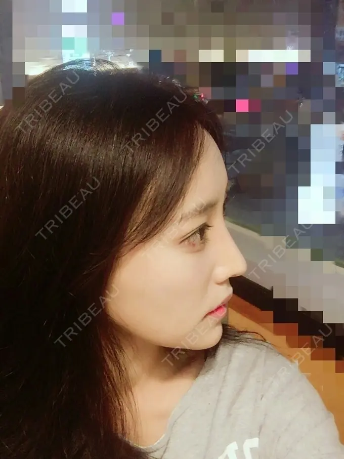 二重埋没 / 隆鼻術 / 鼻尖形成（切開） / 鼻中隔延長（切開） / 骨切り（あご） / 骨削り（エラ） / 骨削り（頬） / 軟骨移植 / ワシ鼻修正・ハンプ切除 DA美容外科 AFTER メイン用