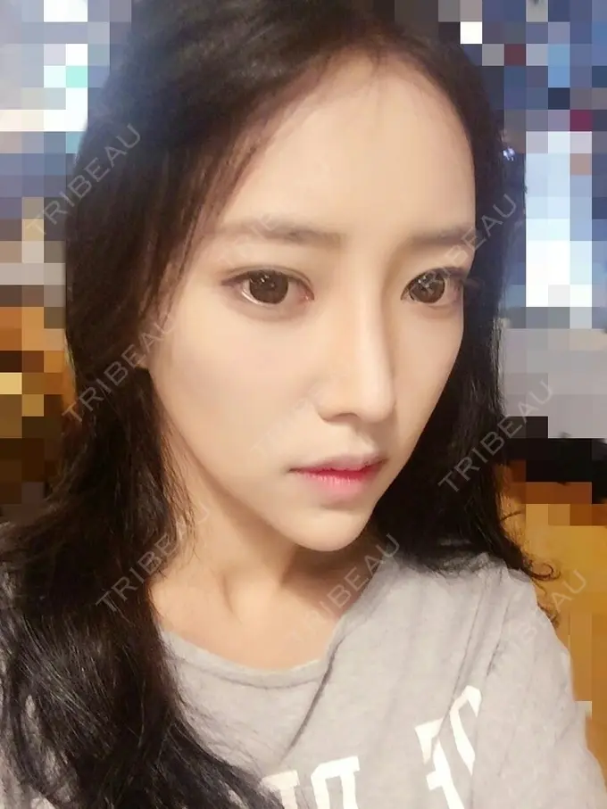 二重埋没 / 隆鼻術 / 鼻尖形成（切開） / 鼻中隔延長（切開） / 骨切り（あご） / 骨削り（エラ） / 骨削り（頬） / 軟骨移植 / ワシ鼻修正・ハンプ切除 DA美容外科 DAY 154 メイン用