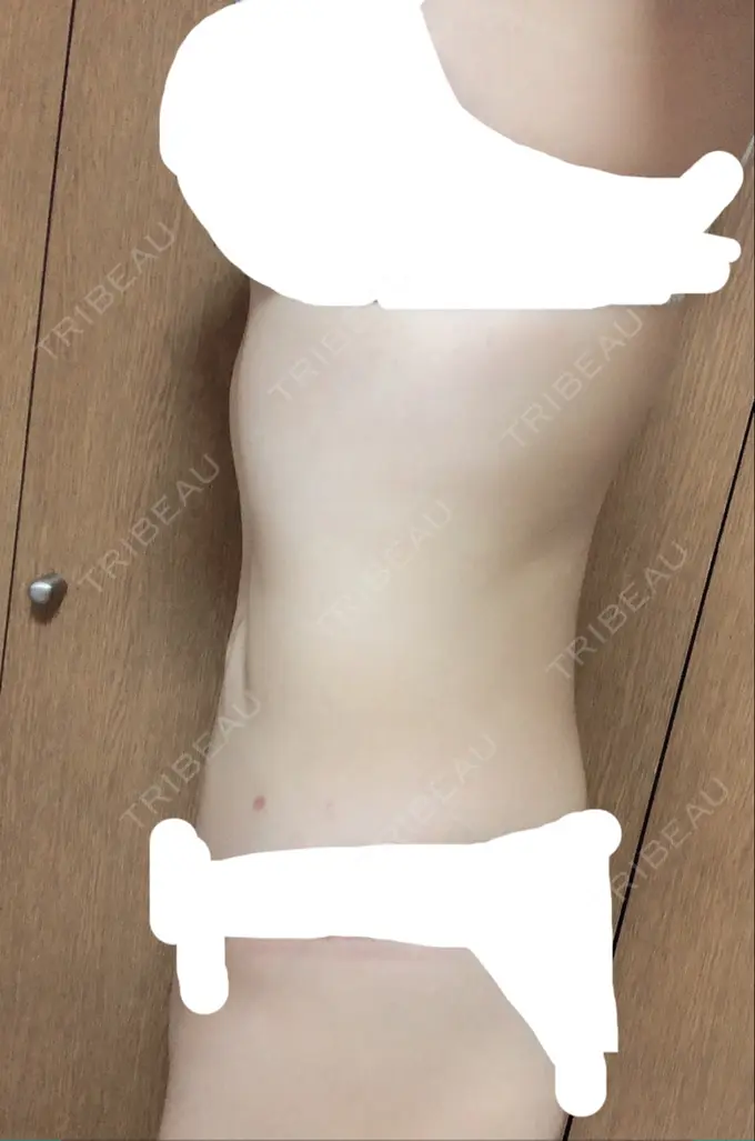 脂肪吸引（お腹） 石倉クリニック 水戸院 DAY 93 メイン用