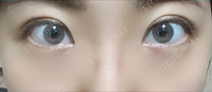 二重埋没 恵聖会クリニック 京橋院 AFTER メイン用