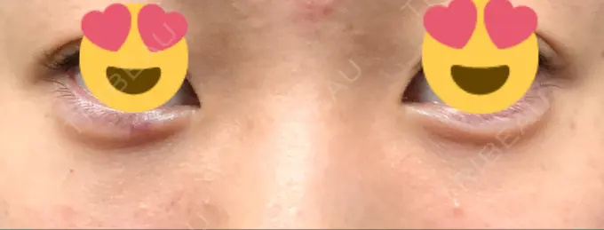 ヒアルロン酸注入（涙袋） / ヒアルロン酸注入（目の下） Wクリニック 心斎橋院 DAY 0 メイン用