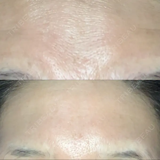 額を丸く / シワ取りボトックス 銀座3丁目・BANNAI美容クリニック DAY 42 メイン用