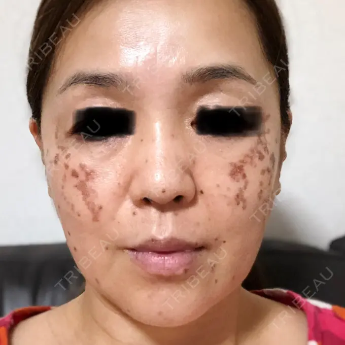 シミ取りレーザー / ピコレーザートーニング（美白・肝斑） / フラクショナルレーザー（毛穴・ニキビ跡） THE ROPPONGI CLINIC（ザ 六本木クリニック） DAY 2 メイン用