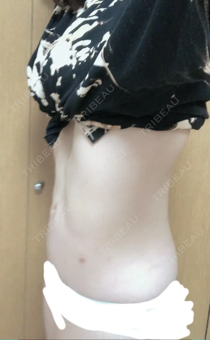 脂肪吸引（お腹） 石倉クリニック 水戸院 DAY 95 メイン用