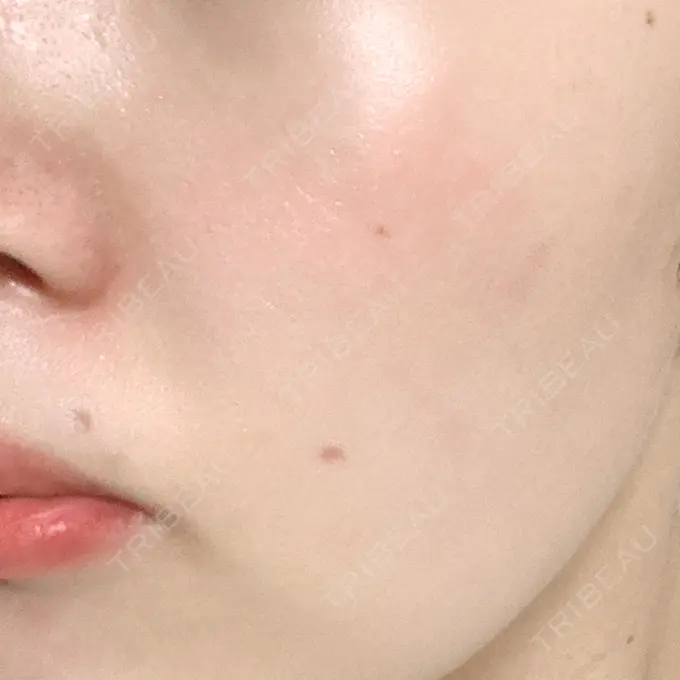 ほくろ・いぼ切除（肌） 品川スキンクリニック大宮院 DAY 21 メイン用