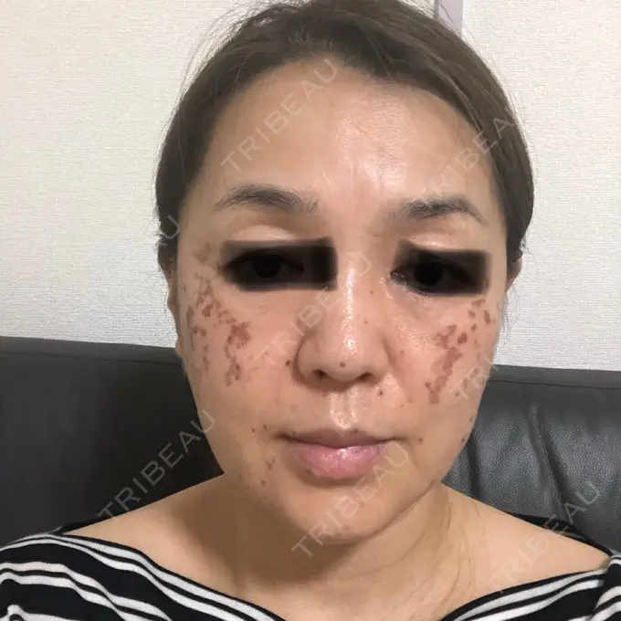 シミ取りレーザー / ピコレーザートーニング（美白・肝斑） / フラクショナルレーザー（毛穴・ニキビ跡） THE ROPPONGI CLINIC（ザ 六本木クリニック） DAY 3 メイン用