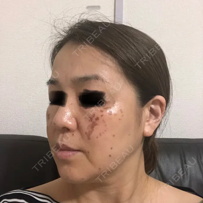 シミ取りレーザー / ピコレーザートーニング（美白・肝斑） / フラクショナルレーザー（毛穴・ニキビ跡） THE ROPPONGI CLINIC（ザ 六本木クリニック） DAY 3 メイン用