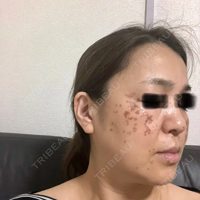 シミ取りレーザー / ピコレーザートーニング（美白・肝斑） / フラクショナルレーザー（毛穴・ニキビ跡） THE ROPPONGI CLINIC（ザ 六本木クリニック） DAY 3 メイン用