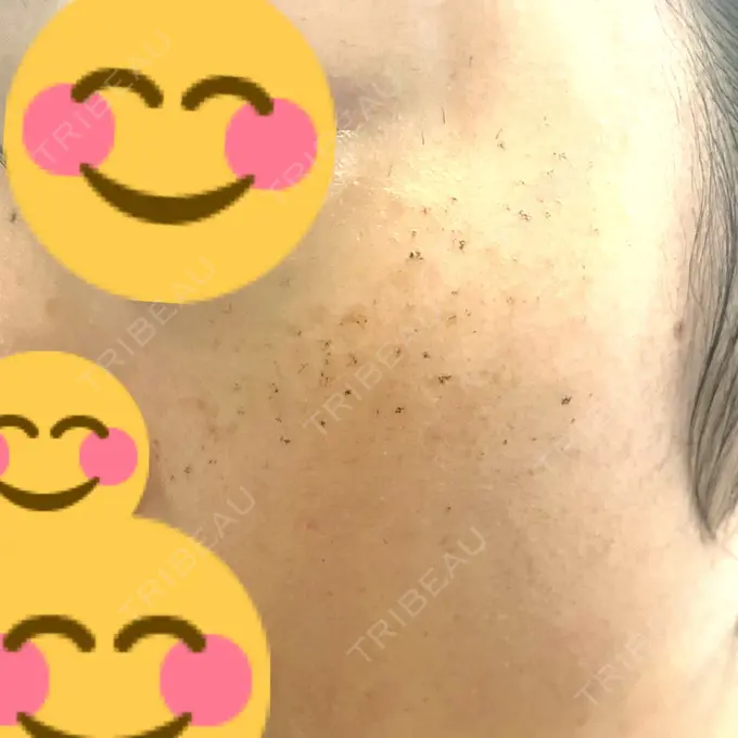 フォトRF ゆり皮膚科 DAY 4 メイン用