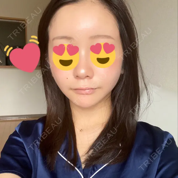 タレ目形成・グラマラスライン（切開） / 切開リフト ドクターゴールドマンクリニック 東京高輪院 DAY 30 メイン用