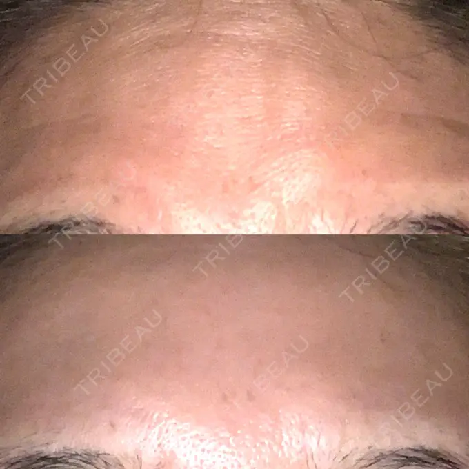 額を丸く / シワ取りボトックス 銀座3丁目・BANNAI美容クリニック DAY 47 メイン用