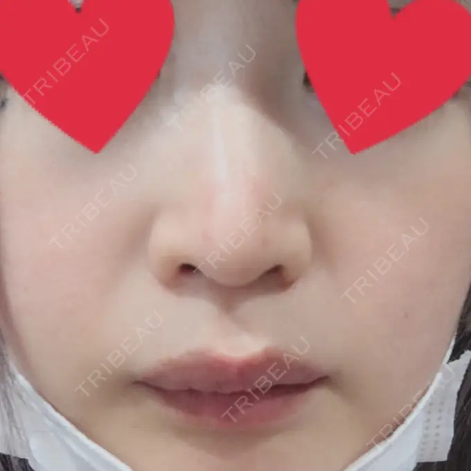 小鼻縮小（切開） / 鼻尖縮小 グレーススキンクリニック AFTER メイン用