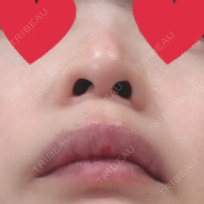 小鼻縮小（切開） / 鼻尖縮小 グレーススキンクリニック DAY 36 メイン用