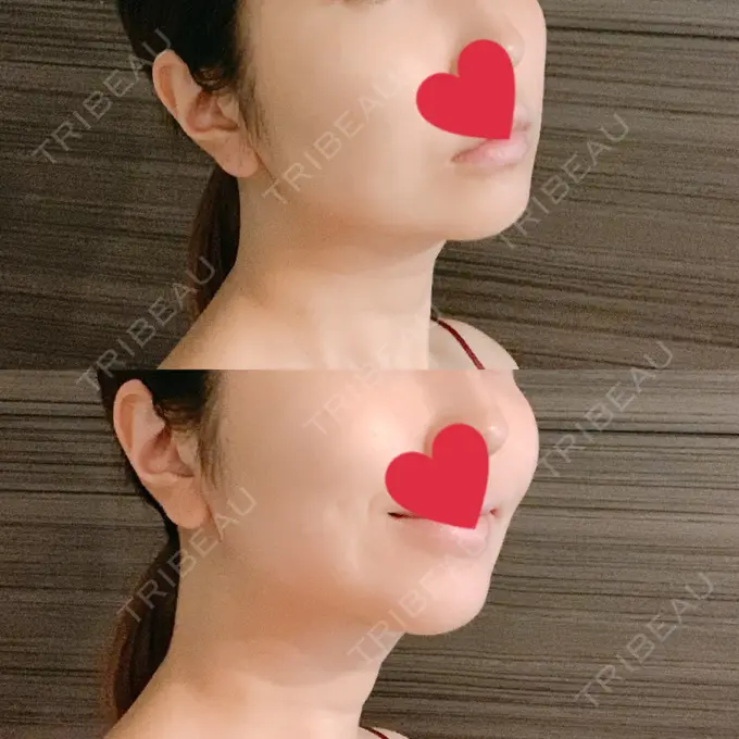 糸リフト / バッカルファット除去 / 脂肪吸引（顔） / メーラーファット除去 / ボトックス（あご） WOM CLINIC GINZA （ワム クリニック ギンザ） AFTER メイン用