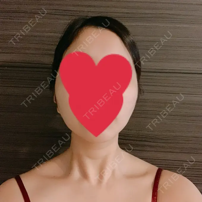 糸リフト / バッカルファット除去 / 脂肪吸引（顔） / メーラーファット除去 / ボトックス（あご） WOM CLINIC GINZA （ワム クリニック ギンザ） DAY 143 メイン用