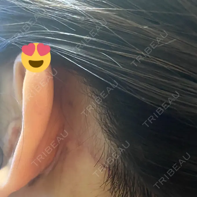 タレ目形成・グラマラスライン（切開） / 切開リフト ドクターゴールドマンクリニック 東京高輪院 DAY 31 メイン用