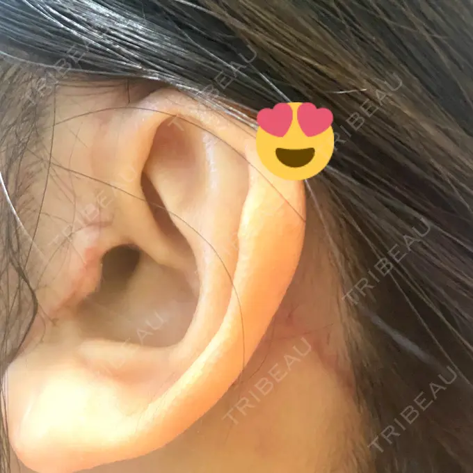 タレ目形成・グラマラスライン（切開） / 切開リフト ドクターゴールドマンクリニック 東京高輪院 DAY 31 メイン用