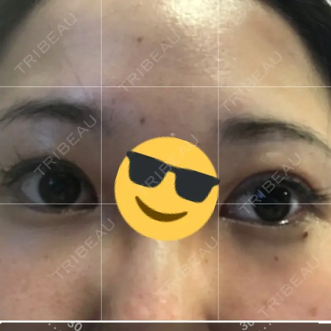 眼瞼下垂（切開） 船橋中央クリニック DAY 9 メイン用