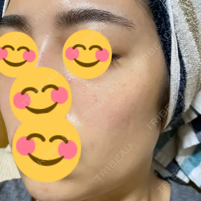 フォトRF ゆり皮膚科 DAY 8 メイン用