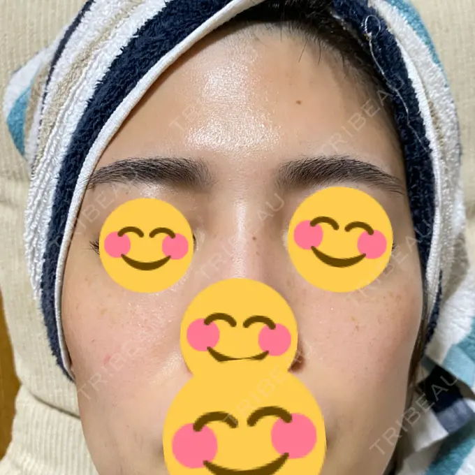 フォトRF ゆり皮膚科 DAY 8 メイン用