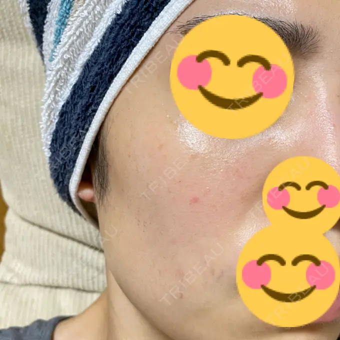 フォトRF ゆり皮膚科 DAY 8 メイン用