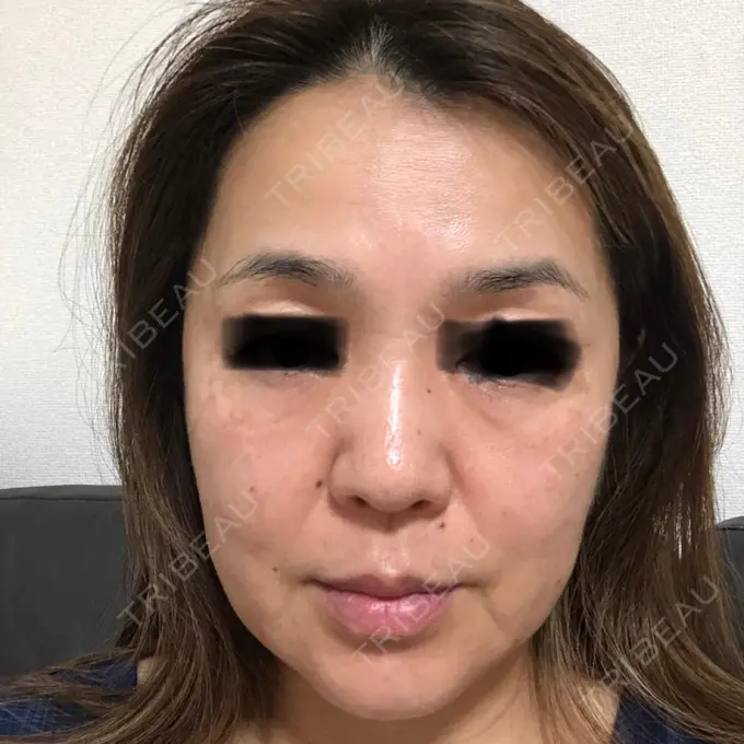 シミ取りレーザー / ピコレーザートーニング（美白・肝斑） / フラクショナルレーザー（毛穴・ニキビ跡） THE ROPPONGI CLINIC（ザ 六本木クリニック） AFTER メイン用