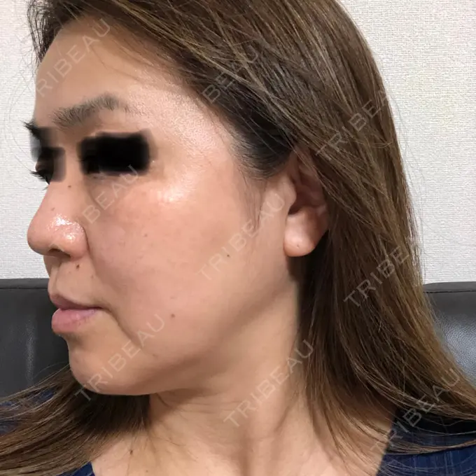 シミ取りレーザー / ピコレーザートーニング（美白・肝斑） / フラクショナルレーザー（毛穴・ニキビ跡） THE ROPPONGI CLINIC（ザ 六本木クリニック） DAY 8 メイン用