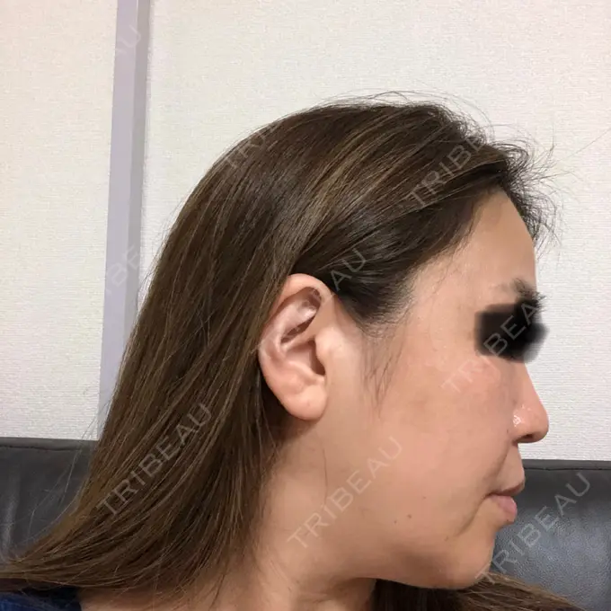 シミ取りレーザー / ピコレーザートーニング（美白・肝斑） / フラクショナルレーザー（毛穴・ニキビ跡） THE ROPPONGI CLINIC（ザ 六本木クリニック） DAY 8 メイン用