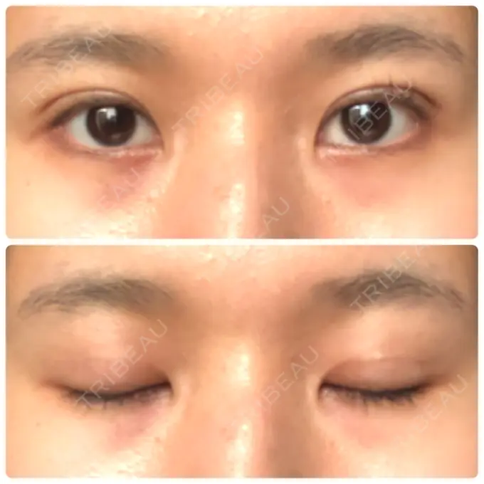 二重埋没 湘南美容クリニック 赤坂見附院 DAY 43 メイン用