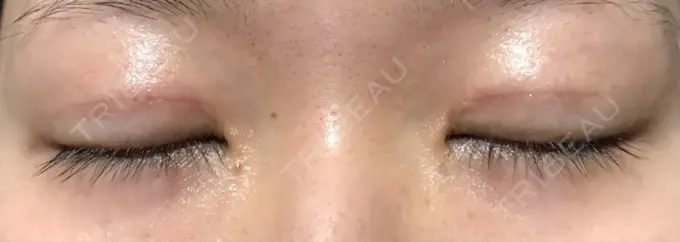 二重切開 きくな湯田眼科 DAY 36 メイン用