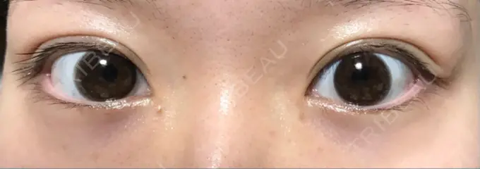 二重切開 きくな湯田眼科 AFTER メイン用