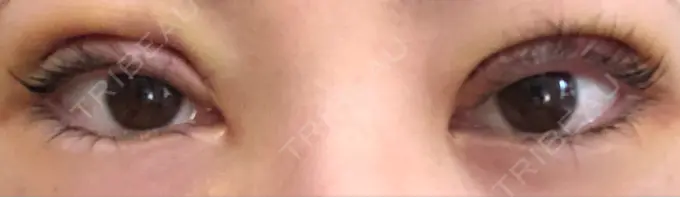 二重切開 城本クリニック 福岡院 DAY 3 メイン用