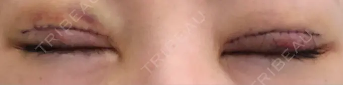 二重切開 城本クリニック 福岡院 DAY 3 メイン用