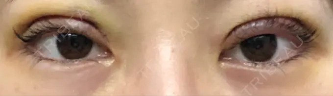 二重切開 城本クリニック 福岡院 DAY 3 メイン用