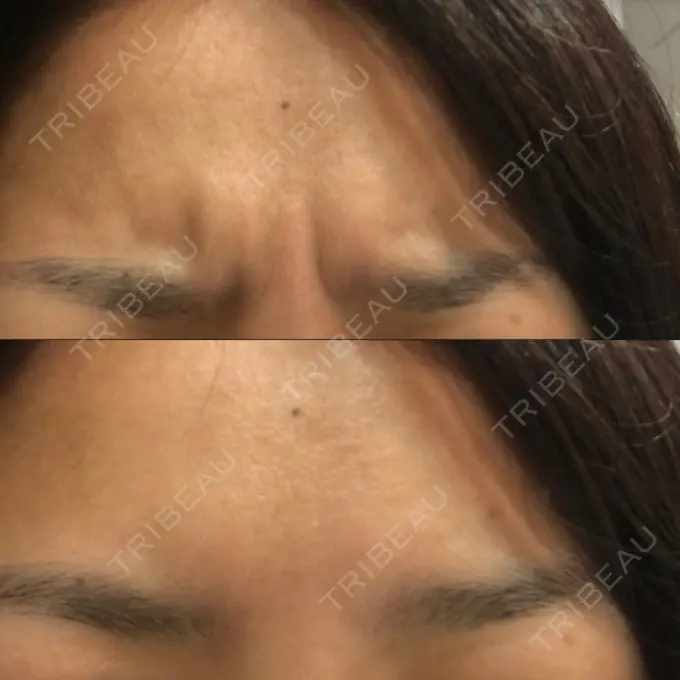 シワ取りボトックス 表参道スキンクリニック 大阪院 DAY 1 メイン用