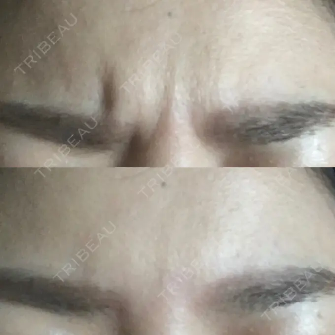 シワ取りボトックス 表参道スキンクリニック 大阪院 DAY 2 メイン用