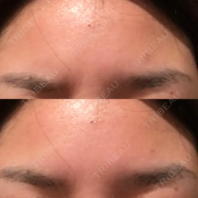 シワ取りボトックス 表参道スキンクリニック 大阪院 AFTER メイン用