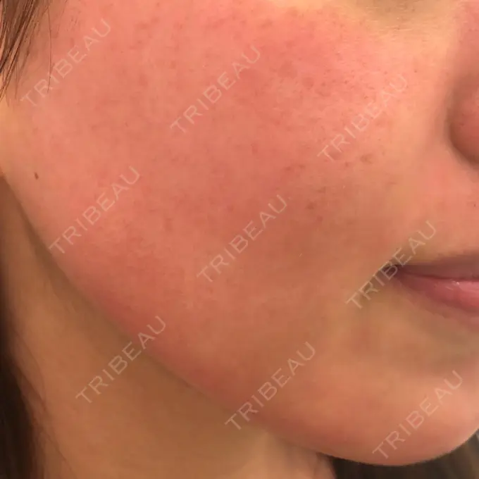 その他（肌） / ダーマペン A CLINIC（エークリニック） 横浜院 DAY 0 メイン用