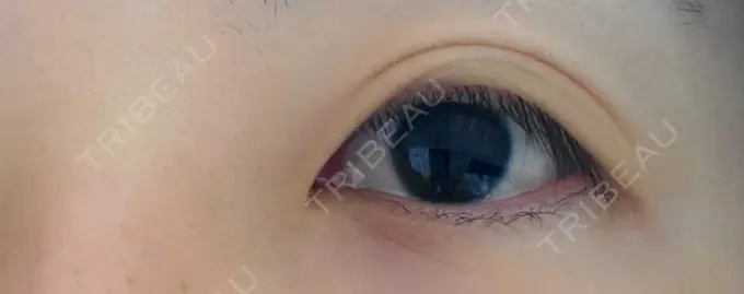 二重切開 ティーズクリニック AFTER メイン用