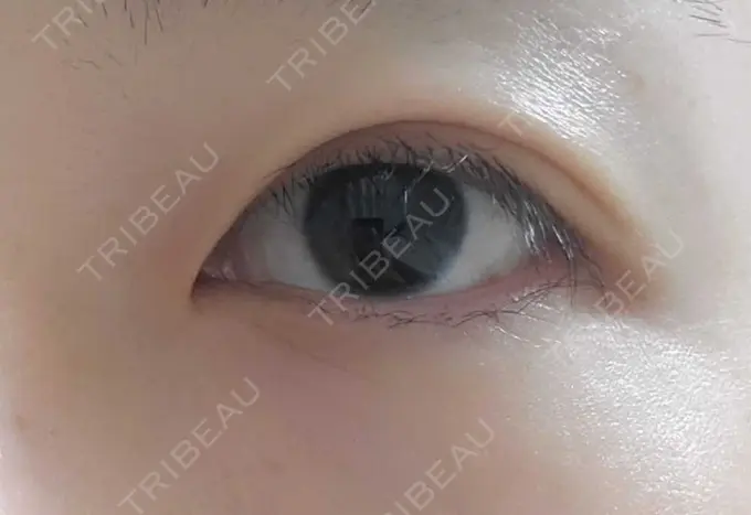 二重切開 ティーズクリニック DAY 218 メイン用