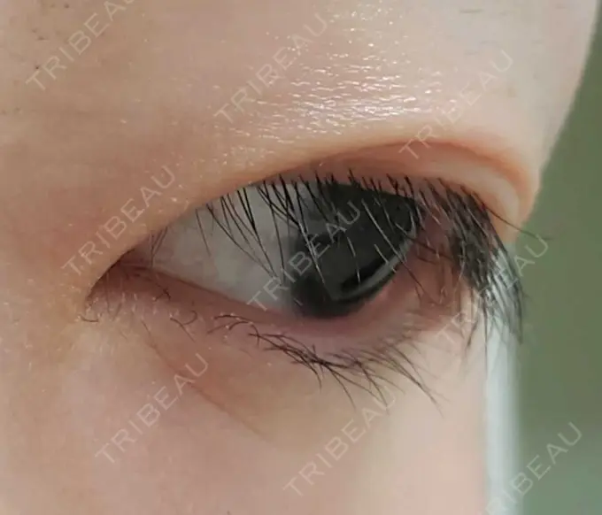 二重切開 ティーズクリニック DAY 218 メイン用