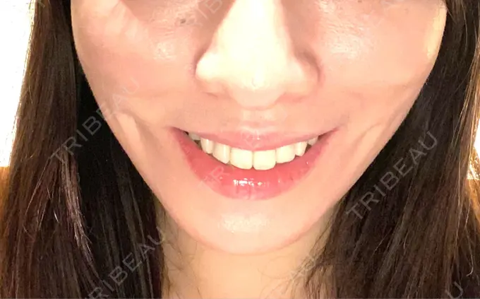 ボトックス（エラ・小顔） / ハイフ（顔） TCB東京中央美容外科 中野院 AFTER メイン用