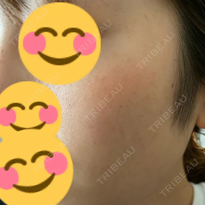 フォトRF ゆり皮膚科 AFTER メイン用