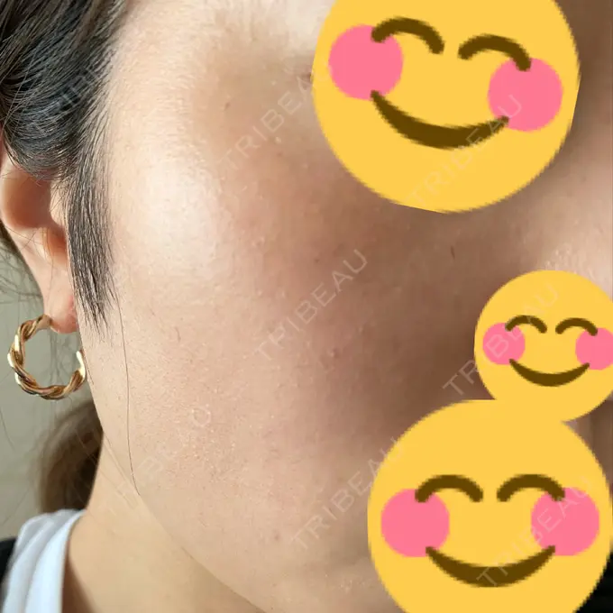 フォトRF ゆり皮膚科 DAY 11 メイン用