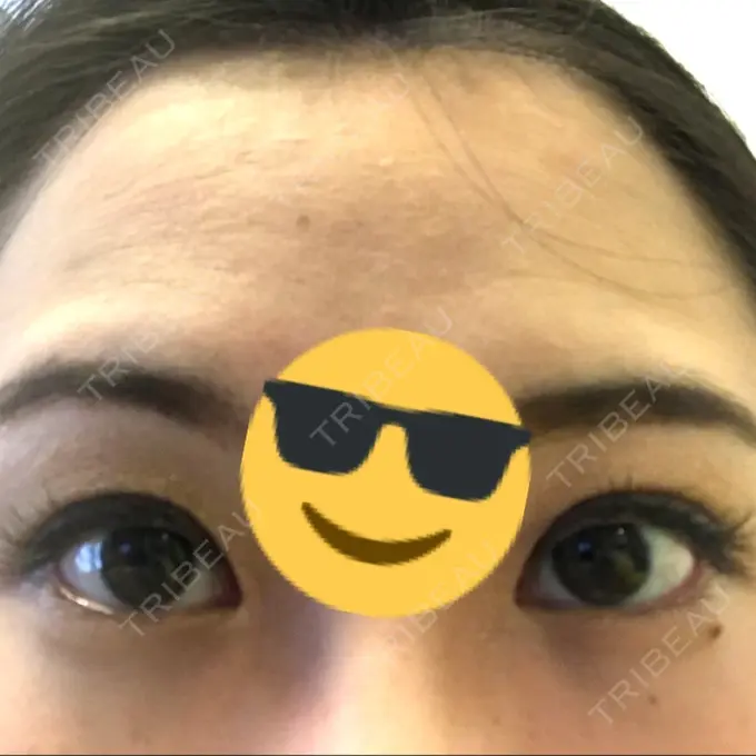 眼瞼下垂（切開） 船橋中央クリニック DAY 10 メイン用