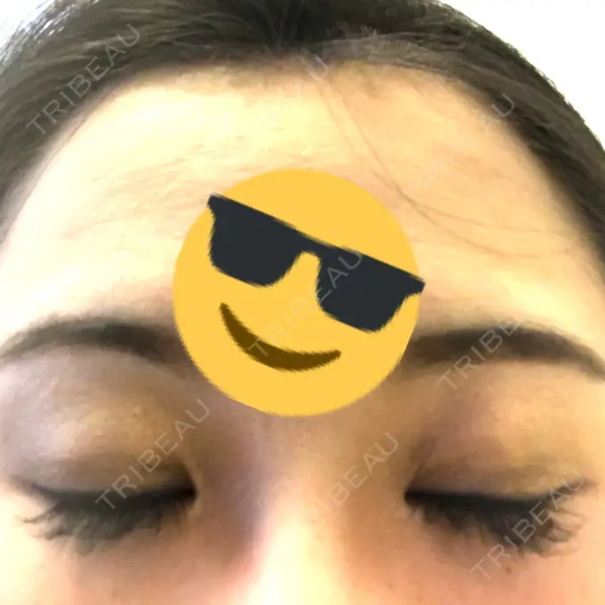 眼瞼下垂（切開） 船橋中央クリニック DAY 10 メイン用