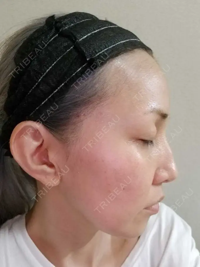 二重埋没 / 糸リフト / クマ治療 / 額を丸く / 下まぶたたるみ取り / 下まぶたの脂肪取り / 脂肪注入（額） / 脂肪注入（輪郭） 湘南美容クリニック 自由が丘院 AFTER メイン用