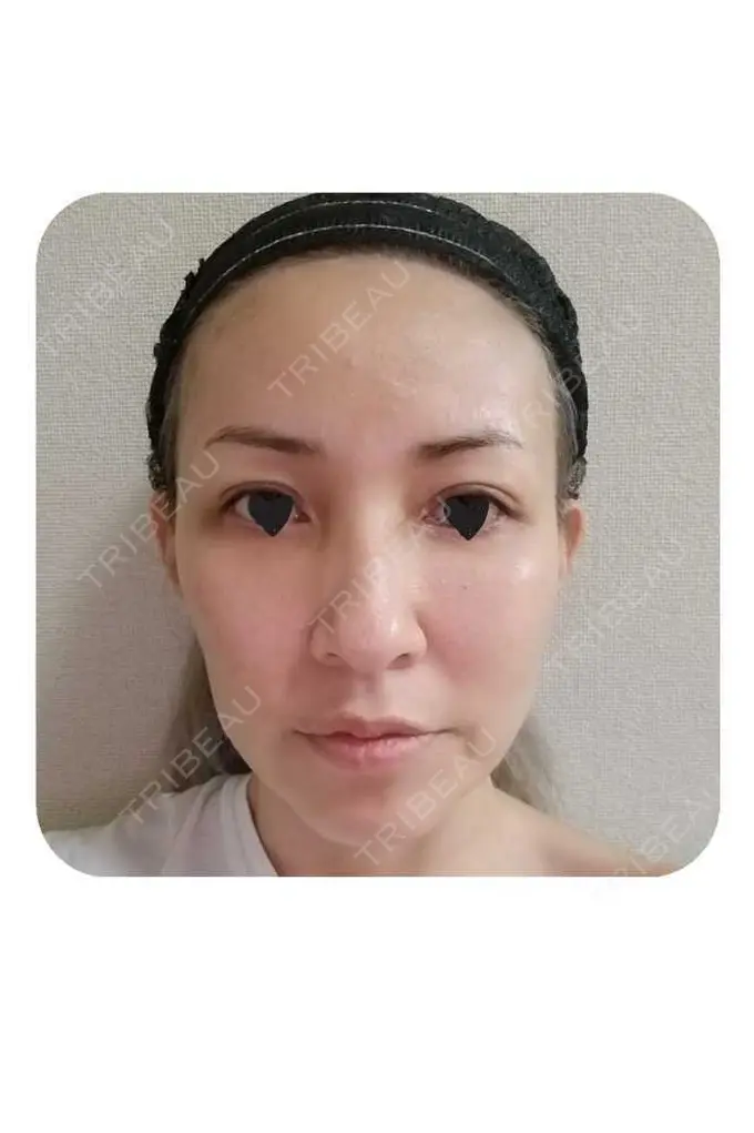 二重埋没 / 糸リフト / クマ治療 / 額を丸く / 下まぶたたるみ取り / 下まぶたの脂肪取り / 脂肪注入（額） / 脂肪注入（輪郭） 湘南美容クリニック 自由が丘院 DAY 50 メイン用