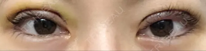 二重切開 城本クリニック 福岡院 DAY 4 メイン用