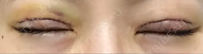 二重切開 城本クリニック 福岡院 DAY 4 メイン用